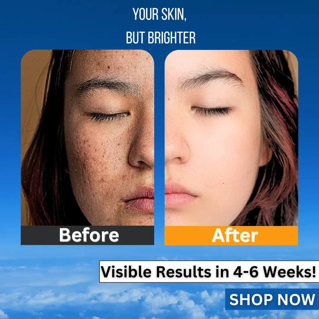 Before and after image of a woman showing improvement from tan pigmentated skin to brighter glowing skin using Vitamin C face Serum